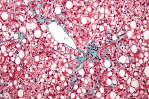 Fatty Liver Disease . Red, Blue, and White Coloring